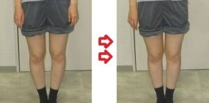 綱島の股関節のO脚、ビフォーアフター